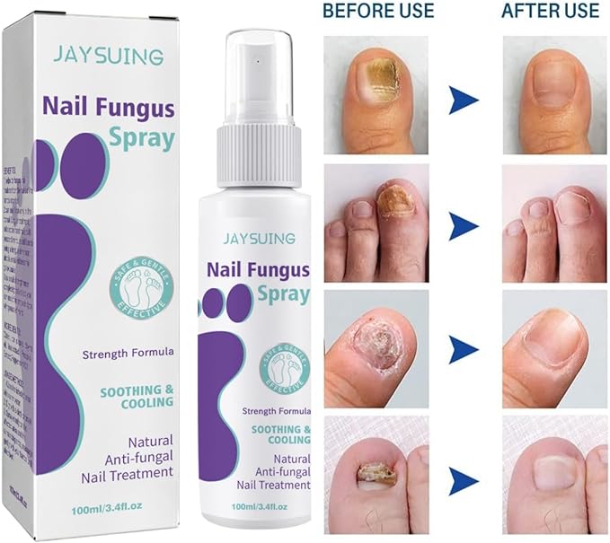 Nail Fungus Spray / رذاذ فطريات الأظافر